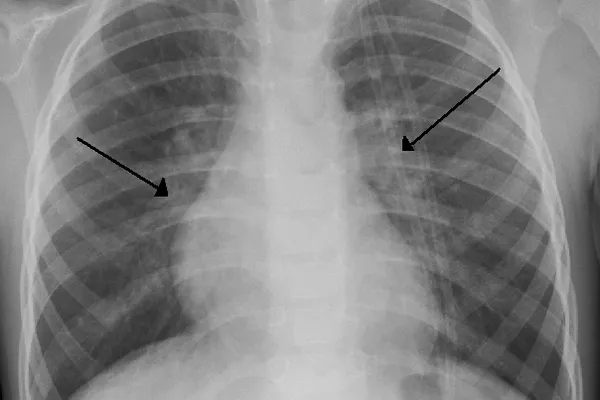 Bronquiolitis causado por VRS - Sputnik Mundo