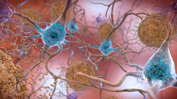 Un cerebro afectado por el Alzheimer - Sputnik Mundo