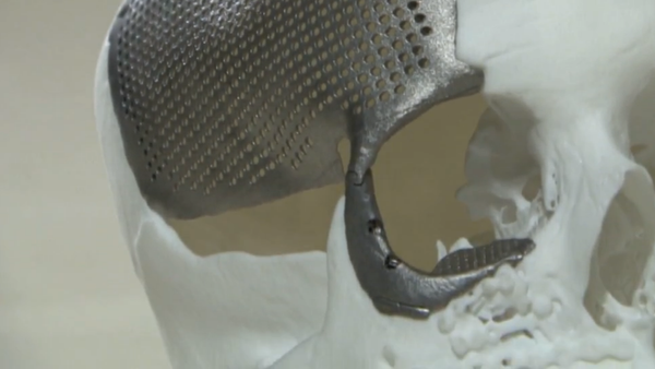 Reconstruyen el cráneo de una joven con titanio impreso en 3D - Sputnik Mundo
