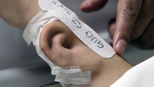 Médicos chinos logran 'cultivar' una oreja en el brazo de un paciente - Sputnik Mundo