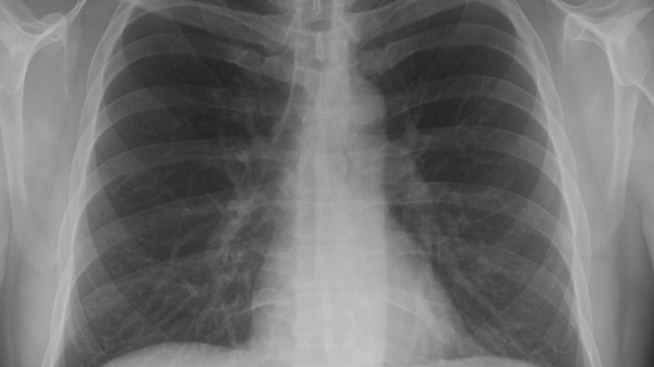 Radiografía de pulmón - Sputnik Mundo