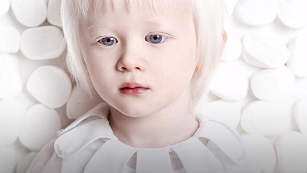 Estos hermanos tienen algo peculiar: son albinos - Sputnik Mundo