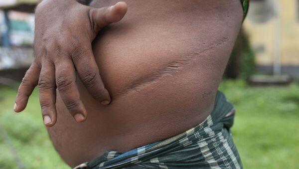 Una de las víctimas del ilegal tráfico de órganos muestra un cicatriz - Sputnik Mundo