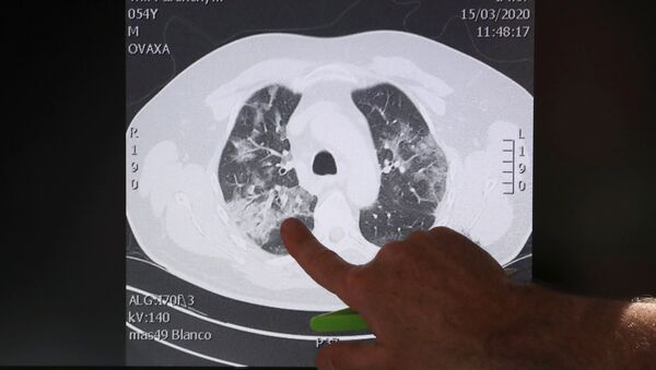 Un examen muestra unos pulmones de un paciente infectado por el COVID-19 - Sputnik Mundo